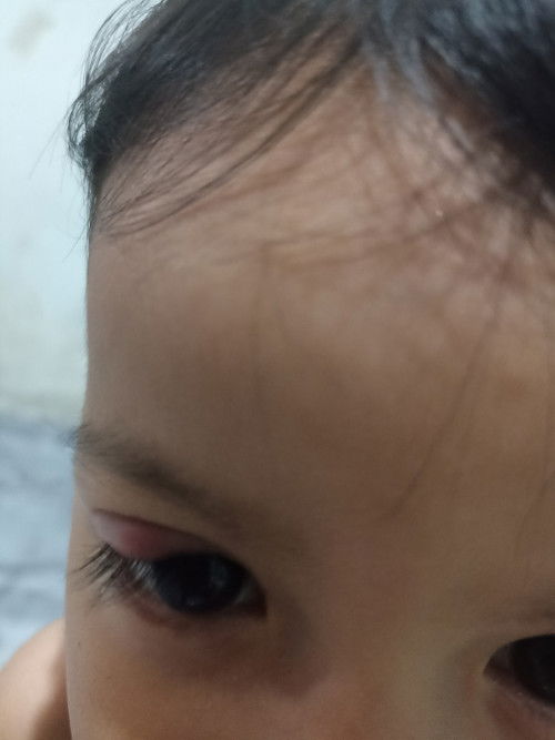 Penyebab mata anak bengkak(bukan karna d gigit serangga)