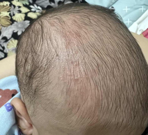 Ruam kulit bagian kepala bayi 1 bulan