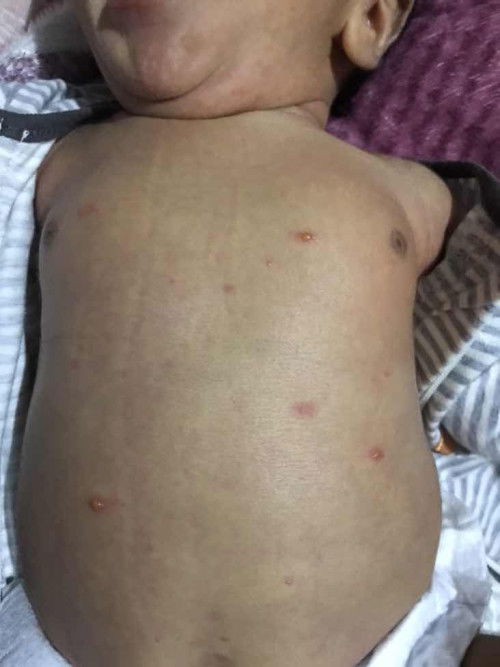 chickenpox in baby???