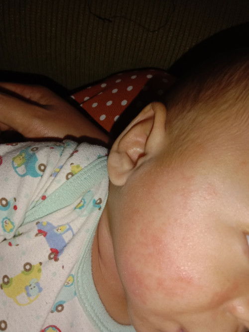 Pipi anak Merah/ruam