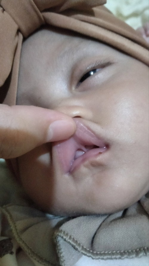 Lip tie pada bayi