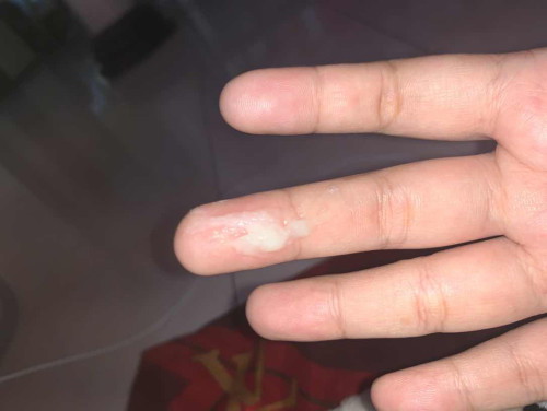 สอบถามแม่ๆค่ะ แบบนี้คืออะไรคะ
ท้องได้30w+3 ค่ะ