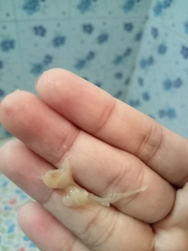 แบบนี้ใช่มูกเลือดไหมคะ