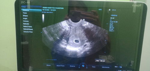 FLEK DI KEHAMILAN 6 WEEK