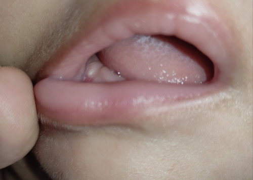 Bintik putih pada gusi bayi