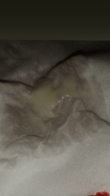 ท้องได้5สัปดาห์มีตกขาวแบบนี้อัตรรายไหมค่ะแม่ๆ