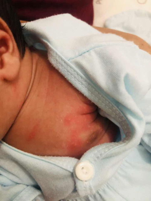 ruam merah pada badan bayi newborn