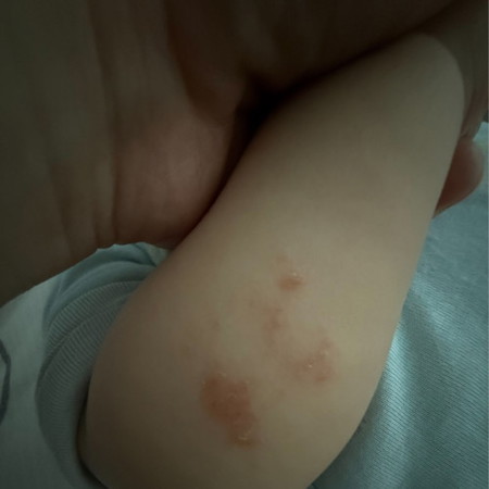 Red spot on baby arm