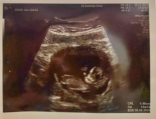 แชร์ประสบการณ์เลือดออกขณะตั้งครรภ์(ไตรมาสแรก) แต่ไม่ใช่ภาวะแท้งคุกคาม