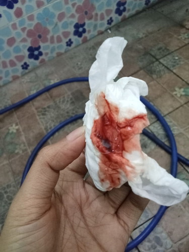 เลือดออกแบบนี้เป็นอะไรไหมคะ