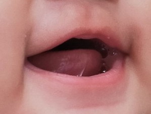 Tongue tied po ba ito mga mommy?