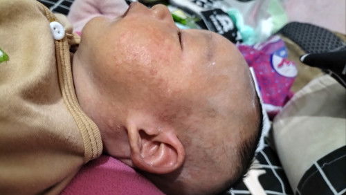 Ruam merah pada bayikk