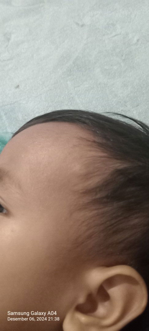 Benjolan kecil di kepala