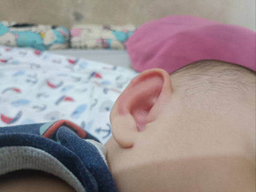 Daun telinga bayi merah dan terlihat bengkak