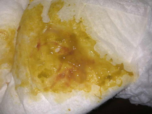 bab bayi 4 bulan berlendir dan ada bercak darah