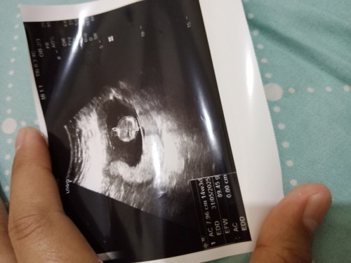 Sharing dong 3 bulan 5 hari
Apakah ini normal??Klu liat usg yg lain kok besar ya kehamilan 3 bulan