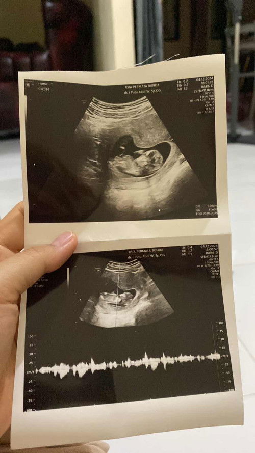 Usia kehamilan 11 minggu