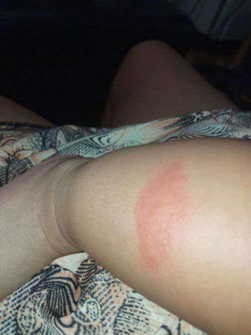 Insect Bites