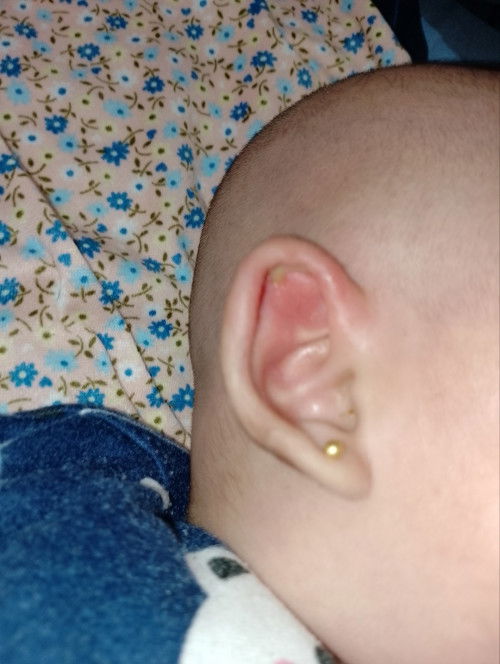 Telenga merah bernanah