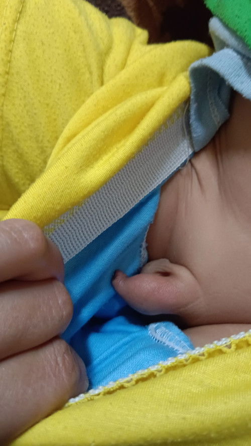 Maaf bun ada yang sama gk anaknya katanya kena fimosis