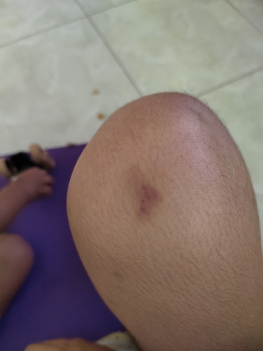 Natural lang po ba magkapasa pasa sa kataean habang nagbubuntis?