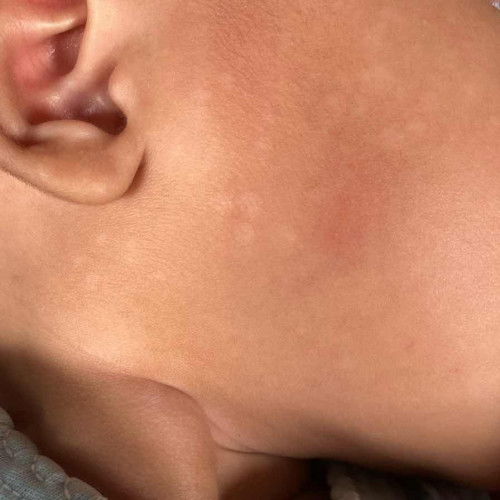 Bantu jawab ya mom baby 4 bulan ada bintik putih di wajah kanan kiri