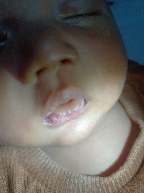 Bibir bayi