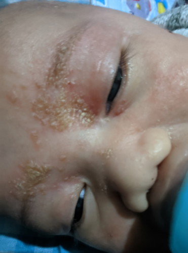 Iritasi/ kerak bayi