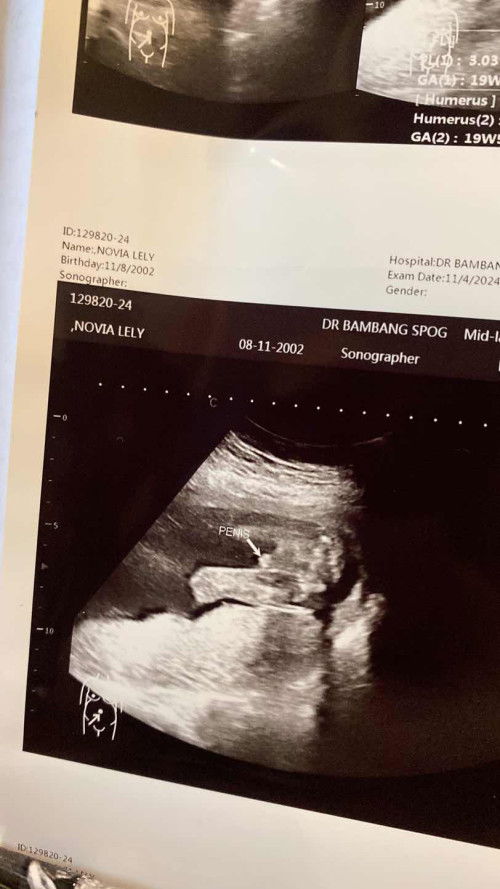Hasil usg jenis kelamin