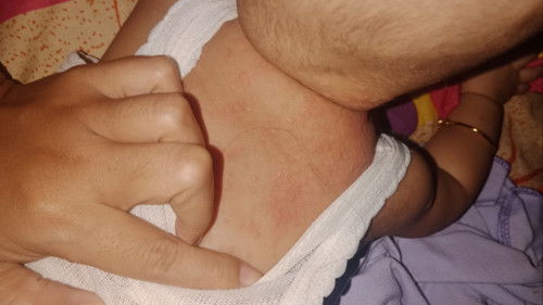 Ruam alergi atau biang keringat