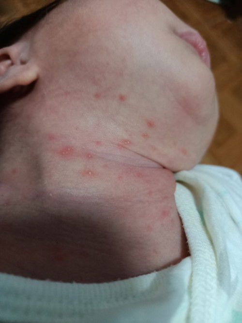 น้องมีผดที่คอ