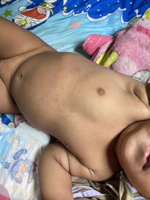 ตื่นมามีผื่นขึ้น......