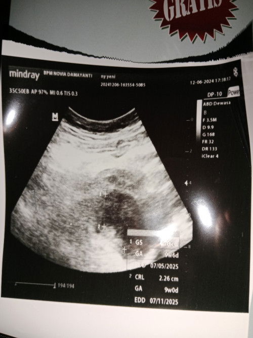 Hasil USG 9minggu untuk ukuran janin segitu normal ga ya bun. Maaf soalnya tidak terlalu paham
