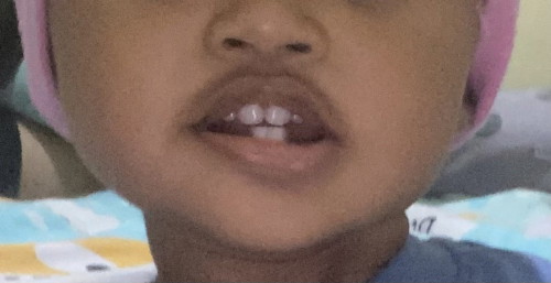 Pertumbuhan gigi anak