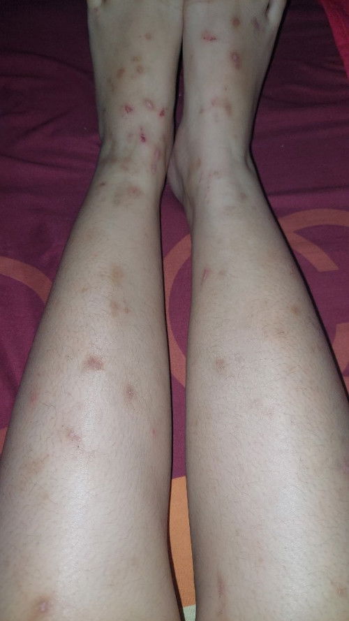 Cara mengatasi gatal gatal seluruh badan