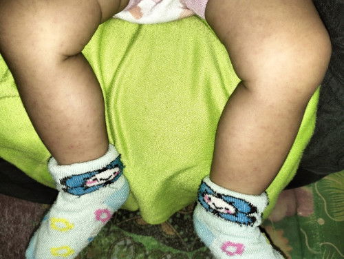 Ini kenapa sams kaki anak saya bund