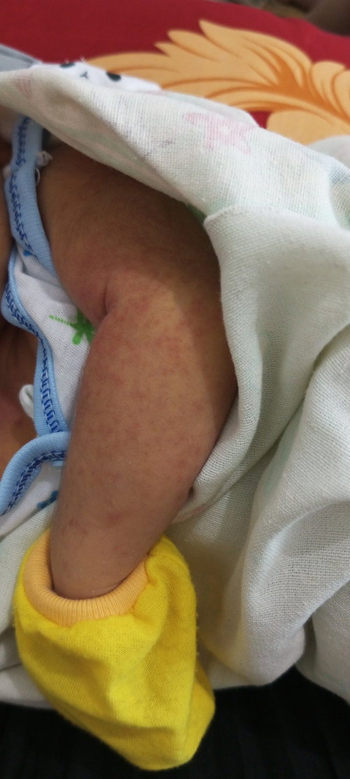 Bintik merah pada bayi baru lahir cara mengatasi