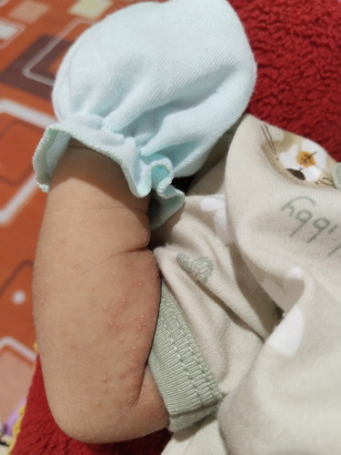 Bunda2, ada yg pernah ngalamin badan anak ruam bintik-bintik kyk gini gk, solusinya apa y??