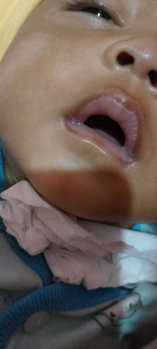 Bibir bayi seperti ini