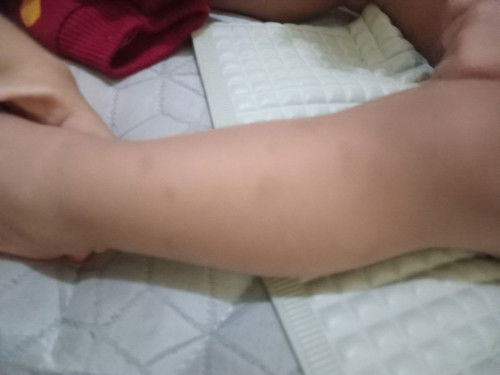 Menghilangkan bekas gigitan nyamuk