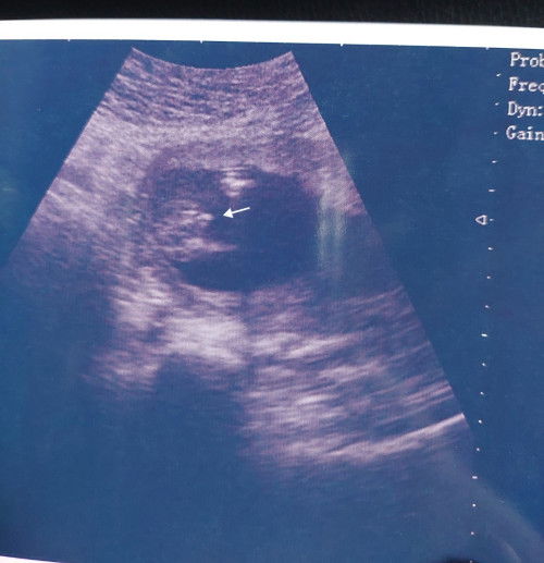 Gender BOY or GIRL ?