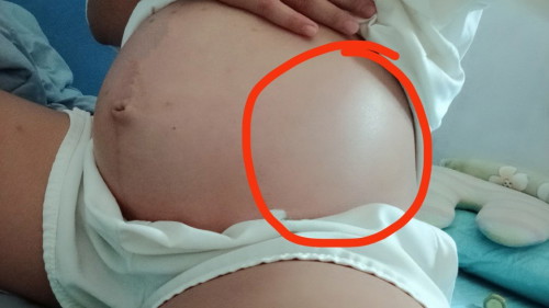 ตรงข้างขวา รู้สึกแข็งมันคือเท้า ของน้องใช่ไหมคะเหมือนจะโดน ถีบแค่ข้างเดียว32.แล้วยังไม่ได้ไปซาวอีก