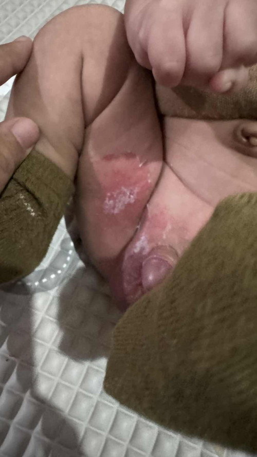 Ruam Bayi di paha bawah
