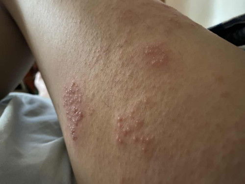 Rashes sa legs at singit