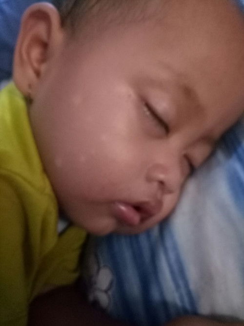 Putih" di pipi bayi 15 bulan