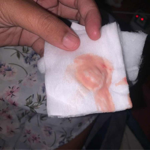 มีน้ำออกมาเป็นเลือดแบบบนี้ควรไปหมอมั้ยค่ะแม่ๆๆๆมีใครเป็นบ้างมั้ยค่ะ37+5🎀🤍