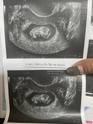 อยากเห็นภาพอัลตร้าซาวด์ตอน 11 w