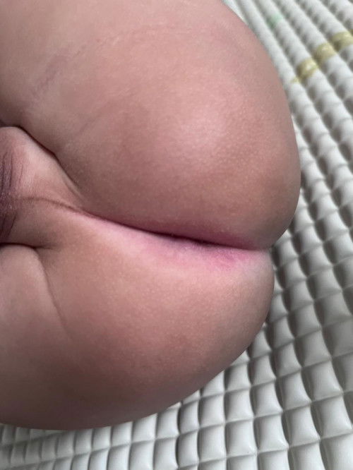 Anus bayi iritas atau lecet