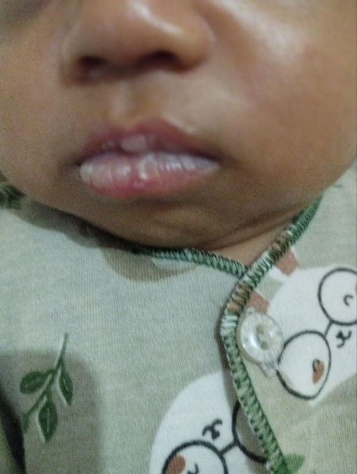 kukit bibir kering kelupas