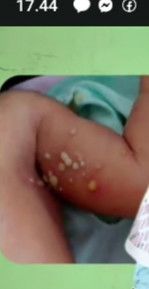 Saran donk Bun obat buat anak sya keluar kyak nanah gtu bagian ketiak trus klo pecah jadi lgi
